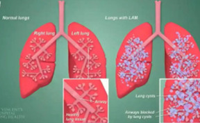 肺靶向和肝靶向LNPs的結(jié)構(gòu)差異，及其在mRNA遞送中的應(yīng)用